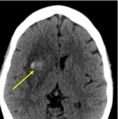 Hemorrhagic transformation of cerebral infarct – Radiology Cases