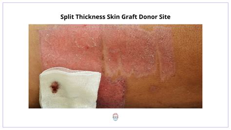 Skin Grafts