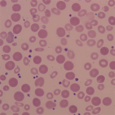 Anisochromia - haematologyetc.co.uk