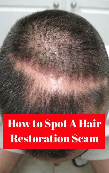 Dr Oz: How To Find a Good Hair Restoration Clinic & Avoid Scams