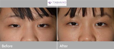 Epicanthoplasty Before and After Gallery | Taban MD