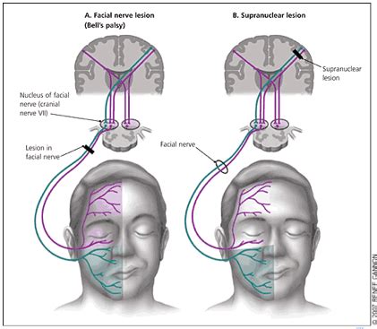 emDOCs.net – Emergency Medicine EducationBell’s Palsy: Pearls and ...