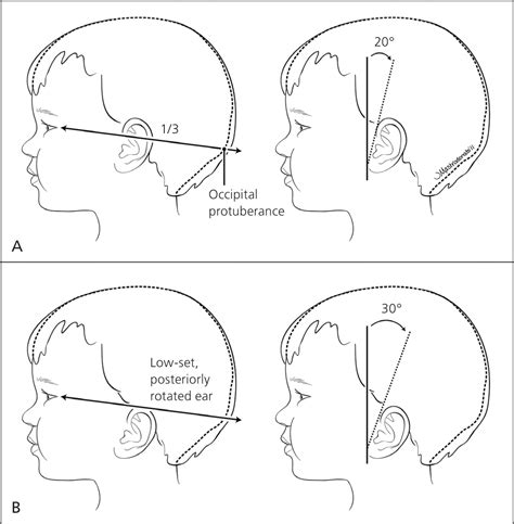 A Comprehensive Newborn Examination: Part I. General, Head and Neck ...