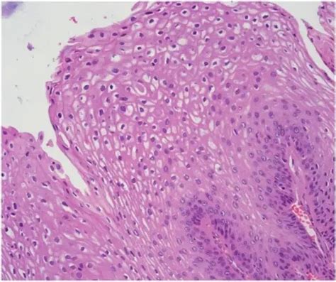 What is Squamous Papilloma of the Larynx? - Pathosomes