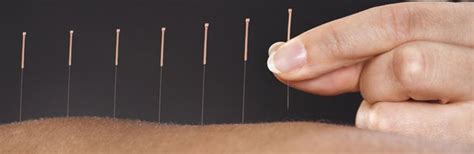 Acupuncture | Traditional Treatment | Westminster, MD