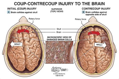 Neuropsychological Evaluation of Traumatic Brain Injury: The Definitive ...