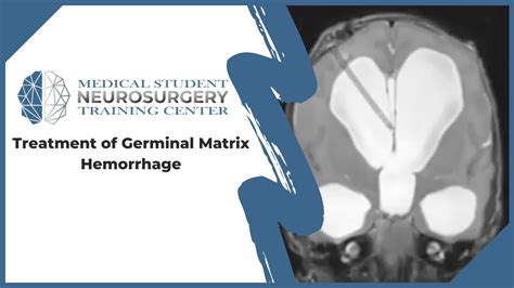 Germinal Matrix Brain Anatomy