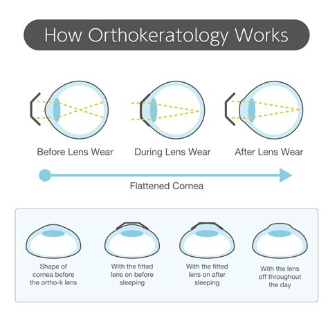 Orthokeratology | Scott Eye Care