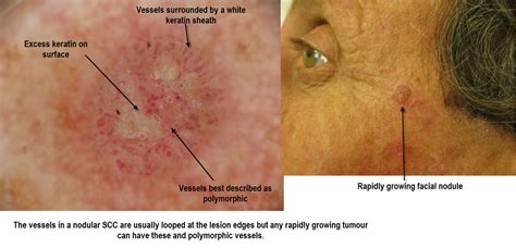 Dermoscopy Made Simple: SCC invasive