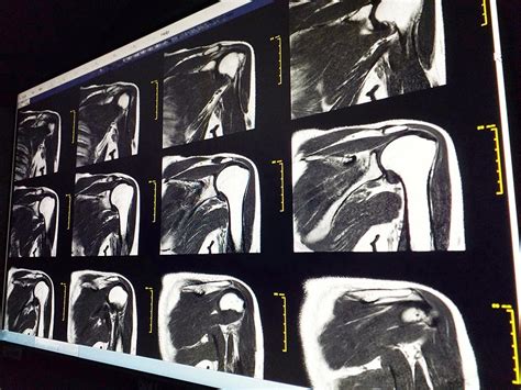 How Do You Prepare For A Shoulder MRI Scan