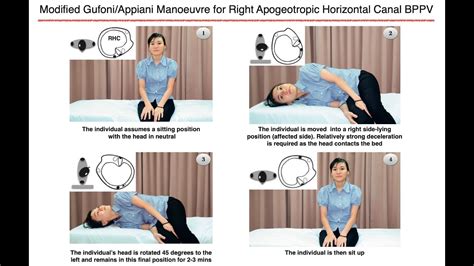 Modified Gufoni/Appiani Manoeuvre for Right Apogeotropic Horizontal Canal BPPV - YouTube