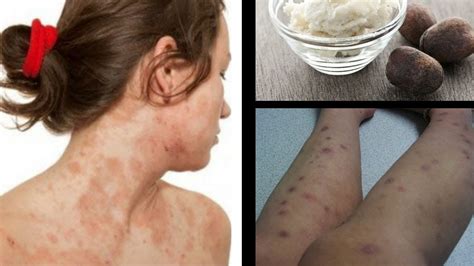 Use This 5 Effective Home Remedies to Cure Eczema Scars - YouTube