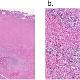 Reported cases of colocutaneous fistula after open tension-free ...