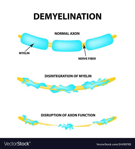 The destruction of the myelin sheath on the axon Vector Image