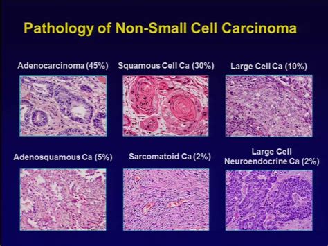 squamous cell carcinoma | Squamous cell carcinoma, Squamous cell, Small ...