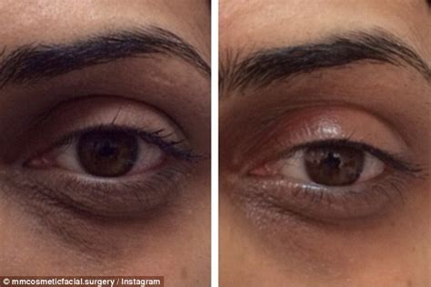 Carboxy therapy injects carbon dioxide under women's eyes for dark circles | Daily Mail Online