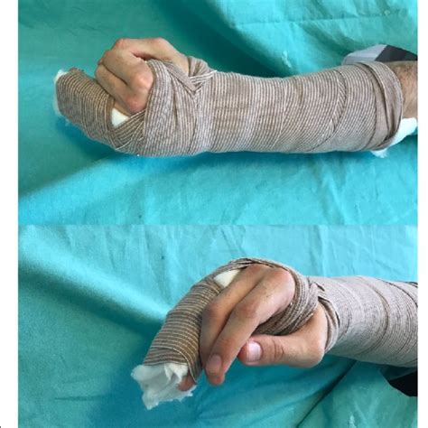 (PDF) Comparison of functional metacarpal splint and ulnar gutter splint in the treatment of ...