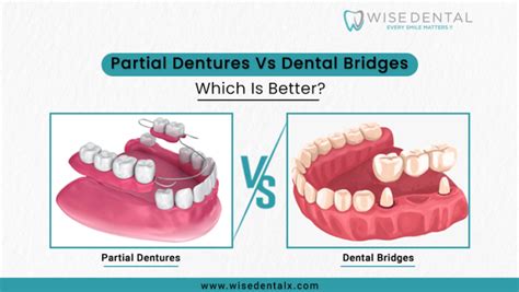 Partial Dentures Vs Dental Bridges - Which Is Better?