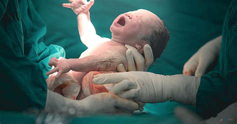 Cesarean Section | Procedure, Indications, Risks, and Complications