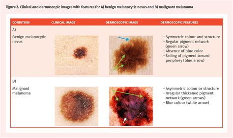 Differentiating malignant melanoma from other lesions using dermoscopy | The College of Family ...