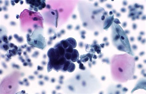 Pap testi | MyPathologyReport.ca