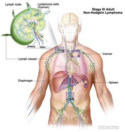 Mantle Cell Lymphoma - Symptoms, Prognosis, Treatment « CancerWORLD Cancer Treatment Research ...