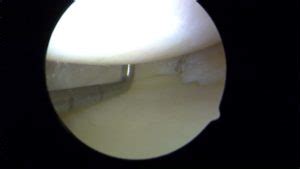 Recovery After Meniscal Tear Surgery - Howard J. Luks, MD