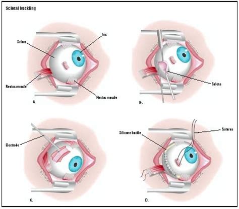 Scleral Buckling - procedure, recovery, removal, pain, complications, time, infection, medication