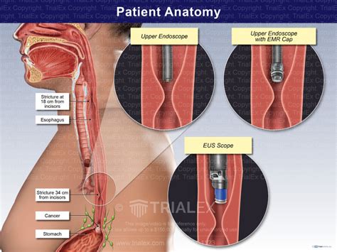 Esophagus Anatomy - TrialExhibits Inc.