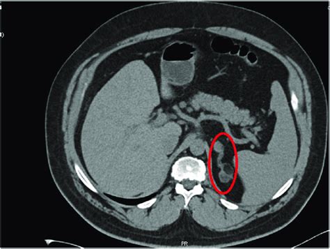 Abdominal CT scan showing an enlarged and thickened left adrenal gland ...