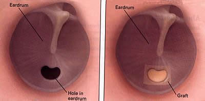 AsherCraft: Getting My EarTubes Removed