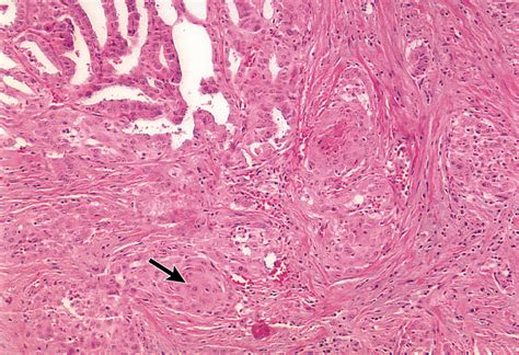 Anaplastic Thyroid Cancer Evolved From Papillary Carcinoma: Demonstration of Anaplastic ...