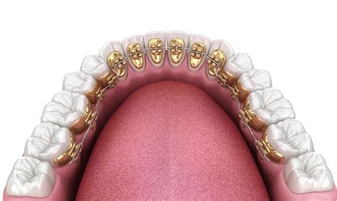 Gold Braces: Pros, Cons & Costs - NewMouth