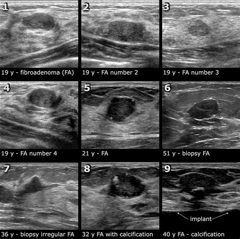 The Radiology Assistant : Ultrasound of the Breast