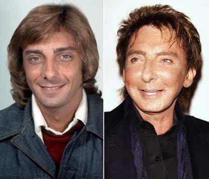 Barry Manilow Plastic Surgery Botox Injections, Facelift Before and After