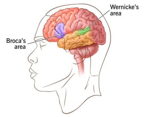 Key Difference Between Broca's and Wernicke's Aphasia