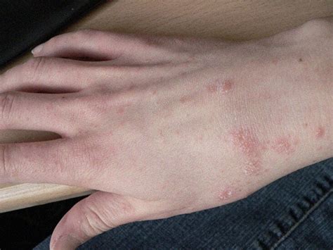 bukle Marksizm Eski Çağlar scabies vs bed bugs silme Kahretsin yılanbalığı