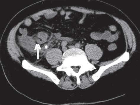 Perforated appendicitis. Plain CT scan shows a dilated | Open-i