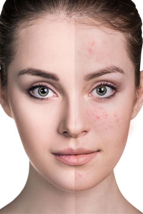 Acne - Andover Dermatology - Exceptional Skin Care & Dermatology Services in Andover, MA & Salem ...