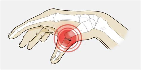 8 Best Thumb Spica Splints for De Quervain’s - Vive Health