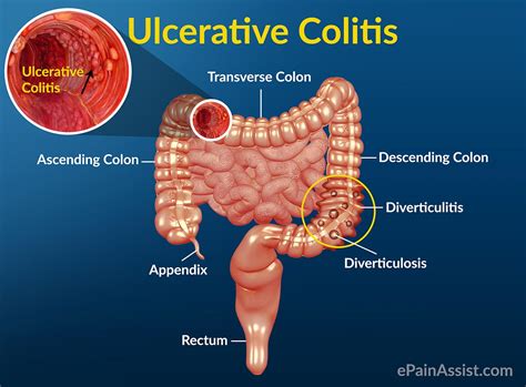 Understanding Ulcerative Colitis – Half Tablespoon