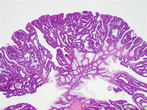 Tubular Adenoma of the Colon