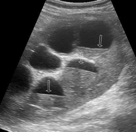 Pyonephrosis | Image | Radiopaedia.org