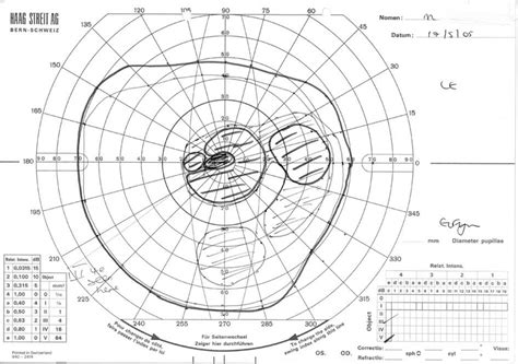 Left Goldmann Visual Field. | Download Scientific Diagram