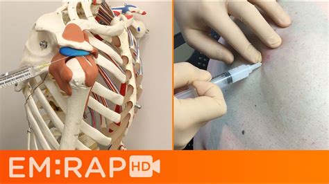 Shoulder Bursa Anatomy