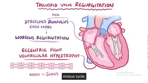 Tricuspid Valve