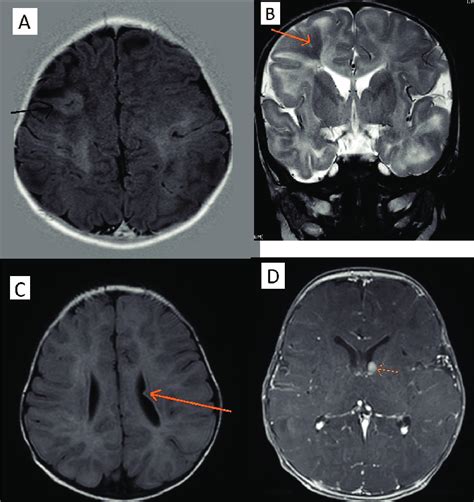 Magnetic resonance imaging brain of Case 1 showing cortical thickening... | Download Scientific ...