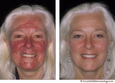 17 Best images about Rosacea on Pinterest | Aspirin, Melaleuca and Skin cancer