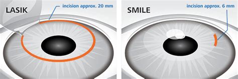 SMILE Eye Surgery in Shreveport, LA | WK Eye Institute