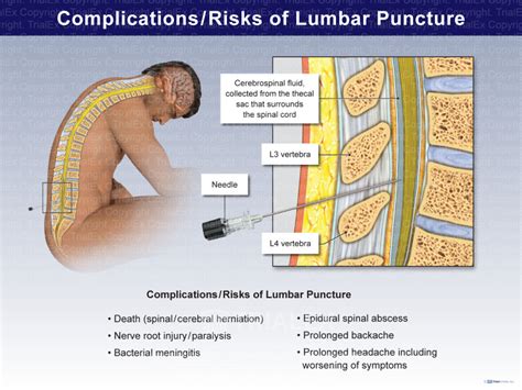 Complications/Risks of Lumbar Puncture - Trial Exhibits Inc.